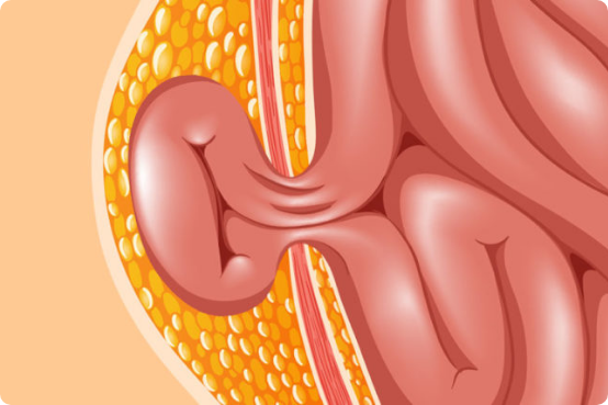 Hernia Diseases