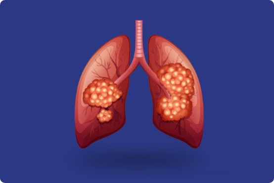 Lung Diseases